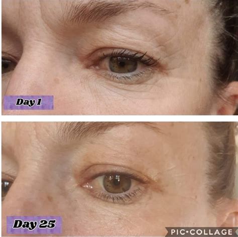 Collagen Before And After Pictures Do You See The Difference