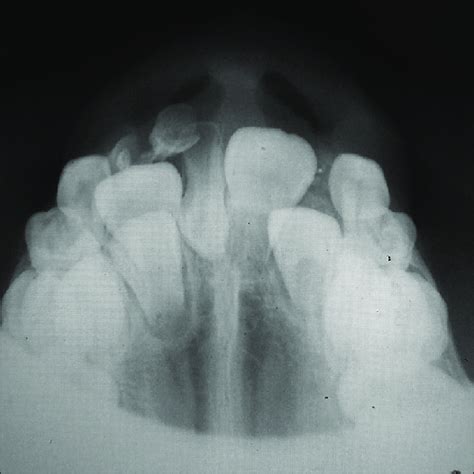 Occlusal Radiograph Confirming The Presence Of Impacted Inverted