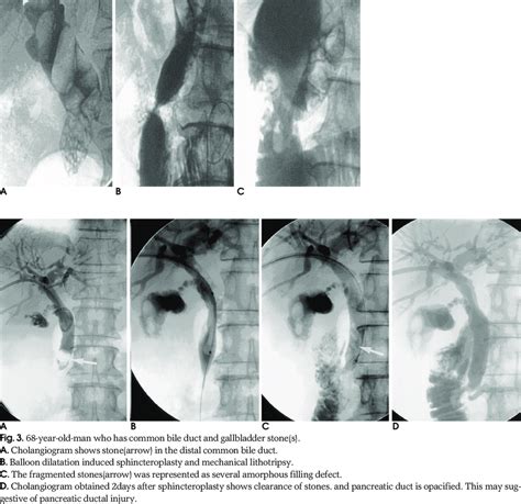 Year Old Woman A Cholangiogram Shows Too Many And Large Stones In