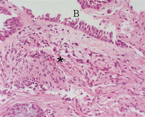 Kaposis Sarcoma Biopsy Showing Endobronchial Lesion Of Kaposis