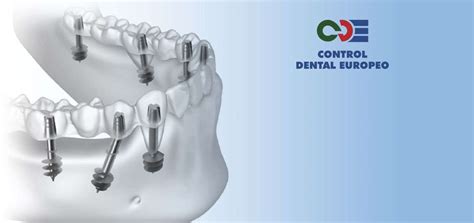 Qu Son Los Implantes Basales Control Dental Europeo