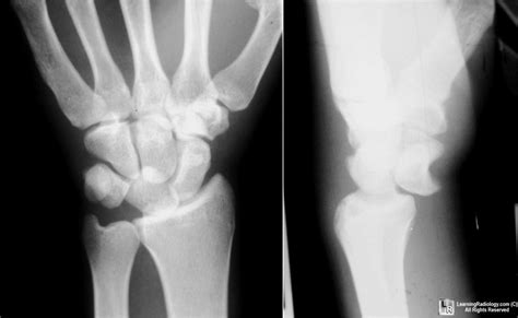 RADIOLOGY, PREGNANCY, INFECTION AND TREATMENT: Barton's Fracture ...