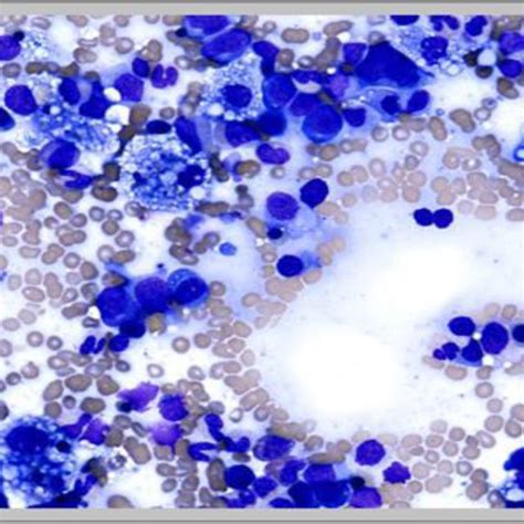 Bone Marrow Aspirate Showing Evidence Of Hemophagocytosis Download