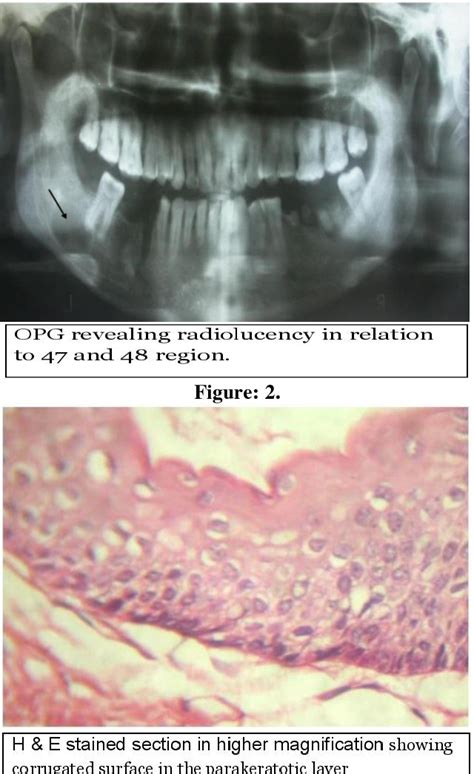 Odontogenic Keratocyst Of The Mandible A Case Report Semantic Scholar