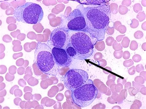 Acute Monocytic Leukemia - 5.