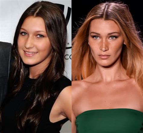 Bella Hadid Plastic Surgery Before And After Who