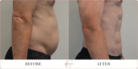 Male Vaser Hi Def Liposuction Before After Gallery