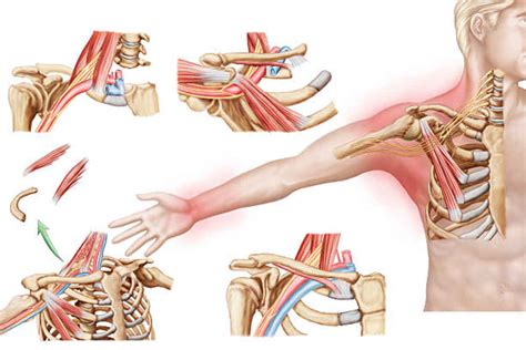 Thoracic Outlet Syndrome - Inspirationi.com