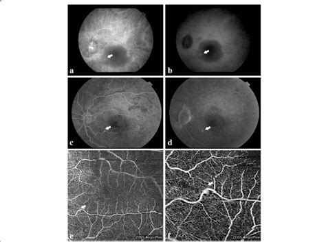 Multimodal Imaging Of The Affected Eye In Case A Icga At The Early