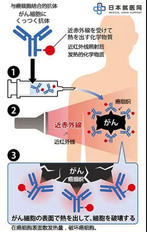 续 癌症光免疫疗法转移复发癌症的终极治疗方法 日本劳动厚生省认定【日本就医网】