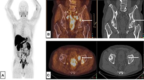 Frontiers Imaging For Metastasis In Prostate Cancer A Review Of The Literature