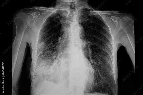 Photo Chest Xray Film Of The Patient With Pneumonia Right Lower Lung