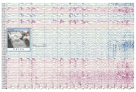 Right Temporal Lobe Seizure Onset In A Patient With Right Hippocampal