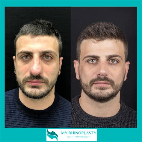 Rinoplastica Cose Da Sapere Prima Dell Intervento My Rhinoplasty