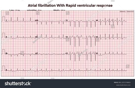 1 Atrial Fibrillation Rvr Images, Stock Photos, 3D objects, & Vectors ...