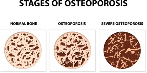 Bone Density And Weight Bearing Exercise