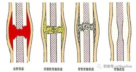 臨床實用骨折癒合過程及癒合時間表 每日頭條