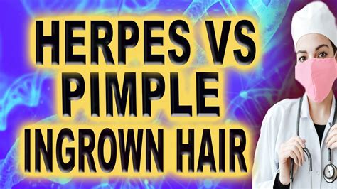 Herpes Vs Pimple Ingrown Hair YouTube