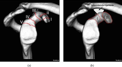 Figure 2 From Acromioclavicular Dislocation Associated With Coracoid Process Fracture Report Of