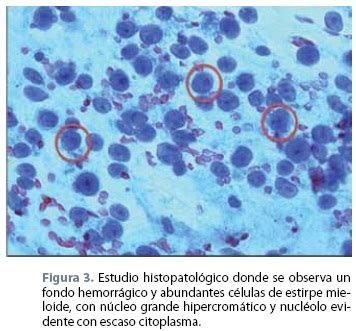 Sarcoma Granuloc Tico En Una Paciente Con Leucemia Mieloide Cr Nica