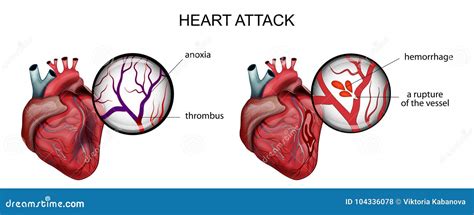 Infarctus Du Myocarde Thrombose Et H Morragie Illustration De Vecteur