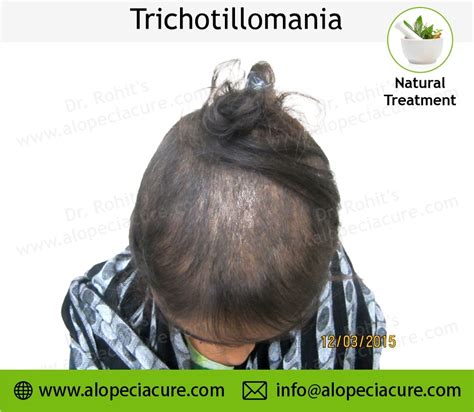 Trichotillomania