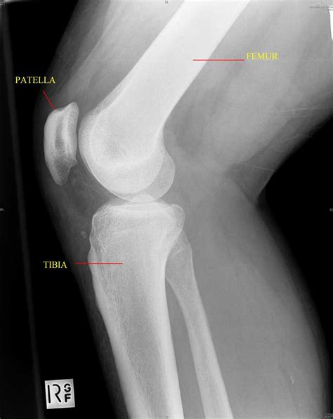 Injuries Knee Dislocation Tibia Fibula