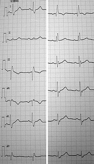 Electrocardiogram Ecg Obtained At Admission Shows Sinus Rhythm