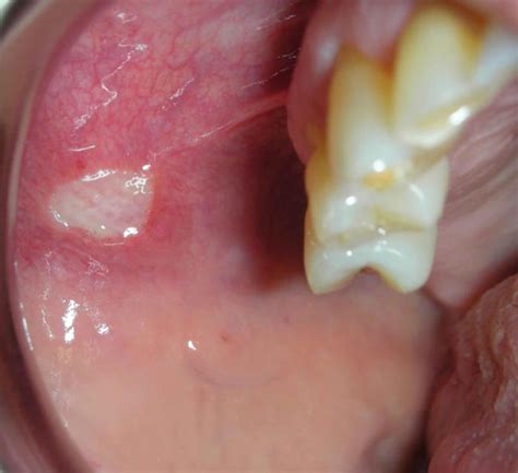 Patologie Comuni Del Cavo Orale Medicina Orale