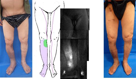 Localized Lymphedema After Treatment For Soft Tissue Sarcoma In The