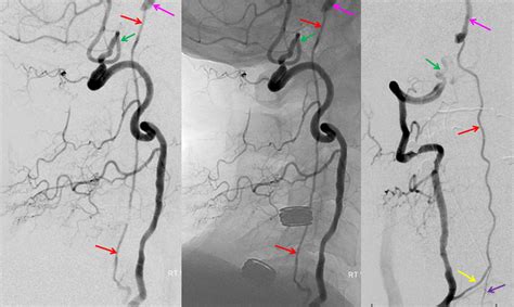 Spinal: Occlusion Of Anterior Spinal Artery