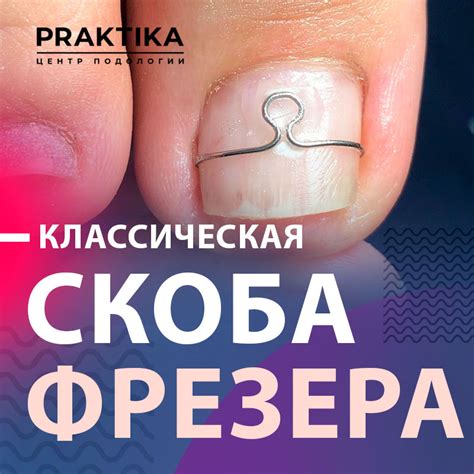 Курс «Классическая скоба Фрезера» за 36500 руб. | Пройти обучение в ...