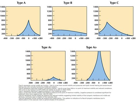 Tympanometry Type B Bilateral at Maryellen Kiefer blog