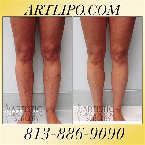 Photo Before And After Liposuction Bbl Surgery Liposuction Procedure