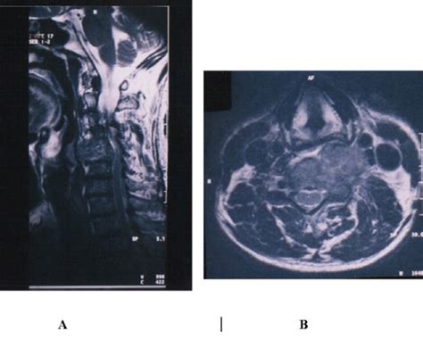 IRM Cervicale En Coupes Sagittale A Et Axiale B En Sp T2 Montrant