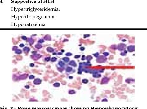 Figure 1 From A Case Report Of Hemophagocytic Lymphohistiocytosis Hlh