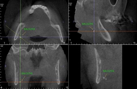 Figure From Incidental Findings From Cone Beam Computed Tomography