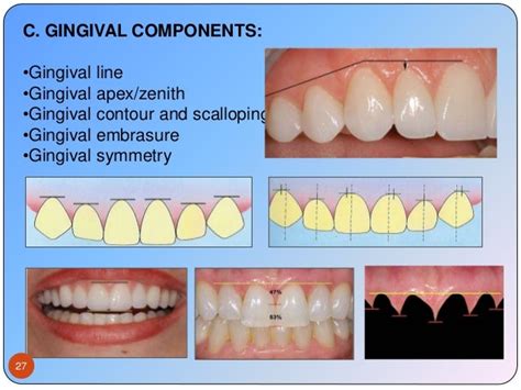 Esthetics In Fpd