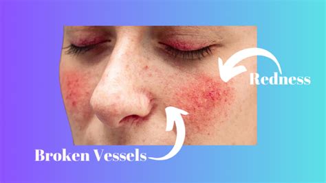 Rosacea Causes And Treatments Dermondemand