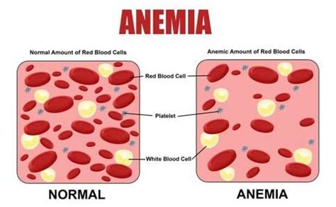 Anemia and its type – Overall Science