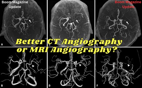 Which Is Better Ct Angiography Or Mri Angiography Daily Amazon Medium