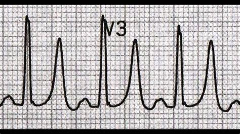 High Magnesium level Hypermagnesemia, symptoms, toxicity, overdose, RN ...