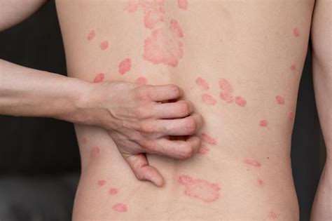 Las Manchas Cut Neas De La Psoriasis Vulgar Son T Picamente Rojas Con