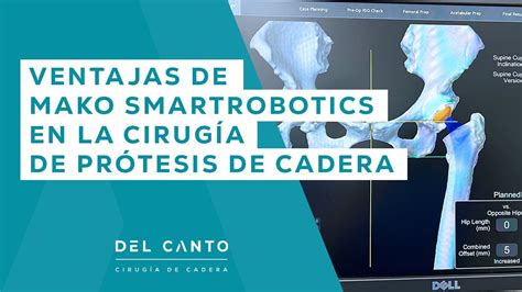 Ventajas De Mako Smartrobotics En La Cirug A De Pr Tesis De Cadera Dr