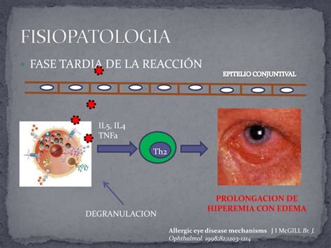 Conjuntivitis Alergica Ppt