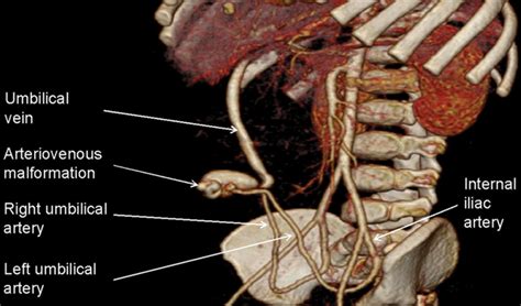 Umbilical Artery