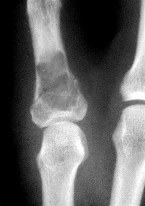 Pathology Outlines Enchondroma Of Hands And Feet