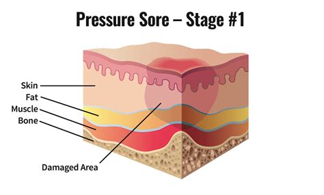 Stage 1 Pressure Ulcer