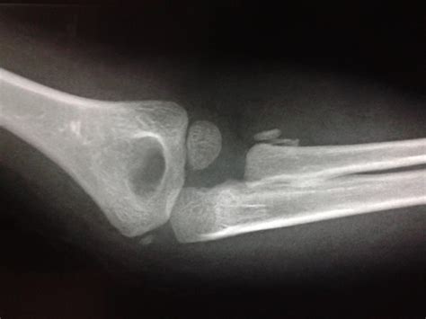 Radial Head And Neck Fractures Pediatric Pediatrics Orthobullets