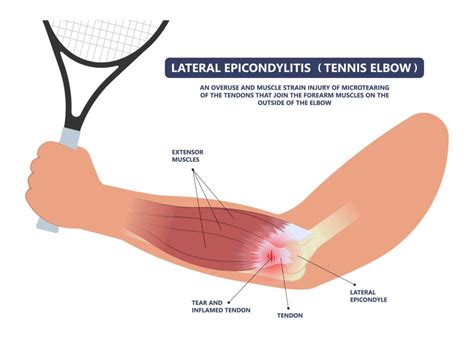 Tennis Elbow Lateral Epicondylitis Motus Physical Therapy